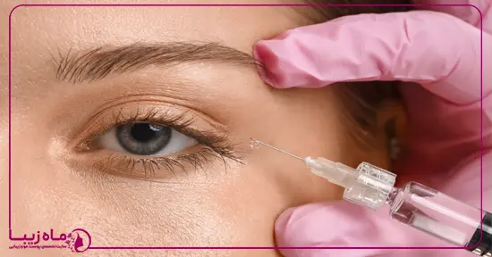 تزریق بوتاکس برای انحراف چشم