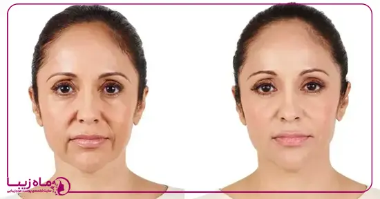برای خطوط لبخند، تزریق بوتاکس بهتر است یا تزریق ژل؟