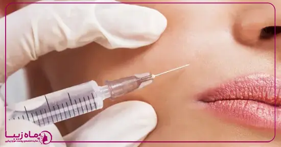 فواید بوتاکس برای خطوط خنده و چین و چروک‌ها