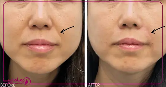 تزریق بوتاکس برای خط خنده
