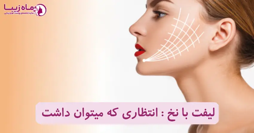 لیفت با نخ