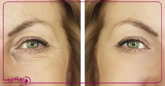هایفوتراپی دور چشم