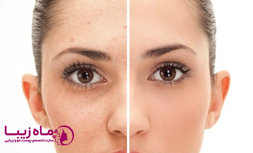 علت لک های قهوه ای صورت چیست؟
