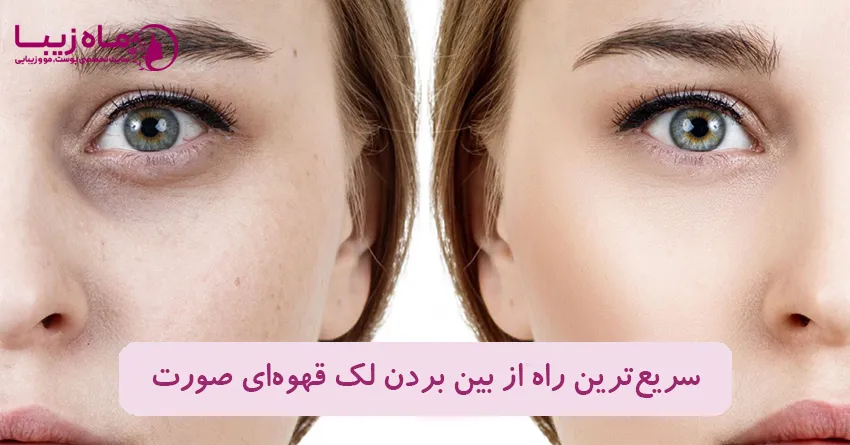 سریع ترین راه از بین بردن لک قهوه‌ای صورت